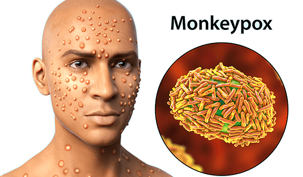 Monkeypox Disinfection